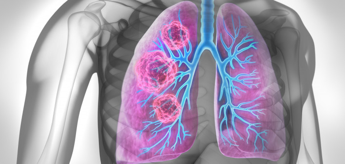 Medical Illustration of lung cancer - cancerous area in lungs