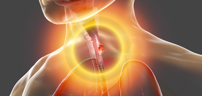 Esophageal cancer, 3D illustration showing malignant tumor in the human esophagus