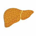 liver steatosis