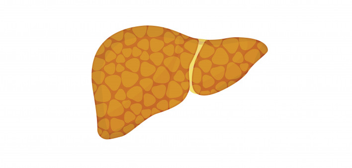 liver steatosis
