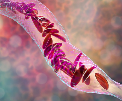 Sickle cell anemia