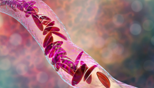 Sickle cell anemia