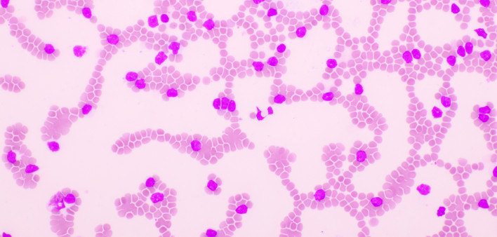 Picture of acute lymphocytic leukemia or ALL cells in blood smear, analyze by microscope, 400x