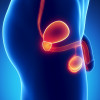 Prostate cancer