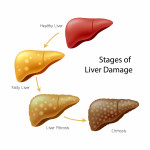 Healthy liver, fatty liver, liver fibrosis and Cirrhosis.  stages of liver damage