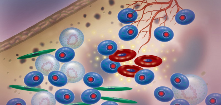 multiple myeloma