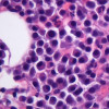 Myeloma cells (purple) in a patient's bone marrow, with a few normal cells in pink in the background.