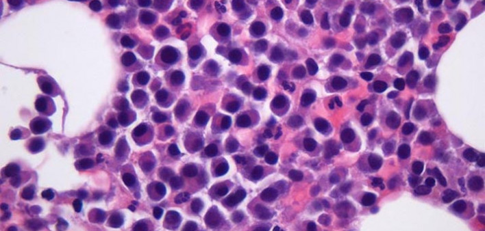 Fred Hutchison, multiple myeloma, bone marrow