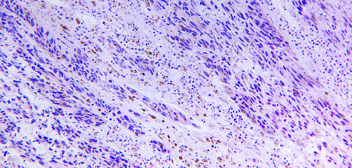 Melanoma of a human, photomicrograph panorama as seen under the microscope, 200x zoom.