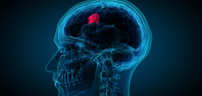 x-ray of brain showing tumor.