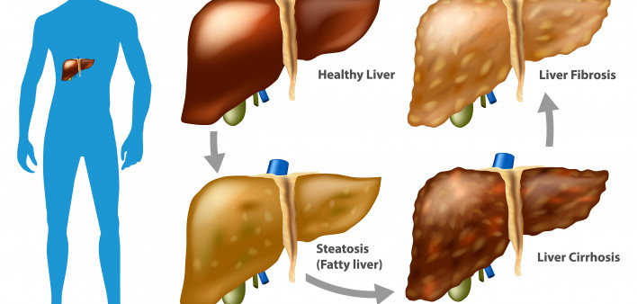 Stages of liver damage. The Progression of Liver Disease. (Steatosis,fibrosis, cirrhosis)