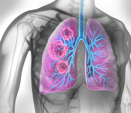 Medical Illustration of lung cancer - cancerous area in lungs