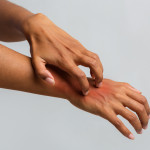 Woman scratching her hand, suffering from psoriasis