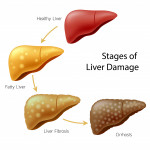 Healthy liver, fatty liver, liver fibrosis and Cirrhosis.  stages of liver damage