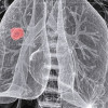 An X-ray of non-small cell lung cancer in a 54-year-old woman