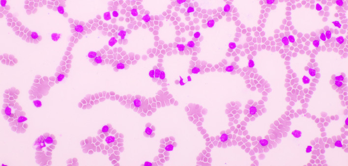 Picture of acute lymphocytic leukemia or ALL cells in blood smear, analyze by microscope, 400x