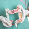 Colon cancer