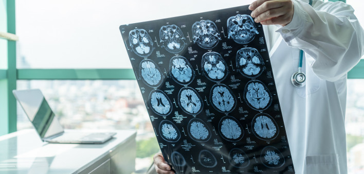 doctor looking at mri of brain