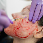 woman gets Revolutionary treatment of rejuvenation with blood plasma vampire facial