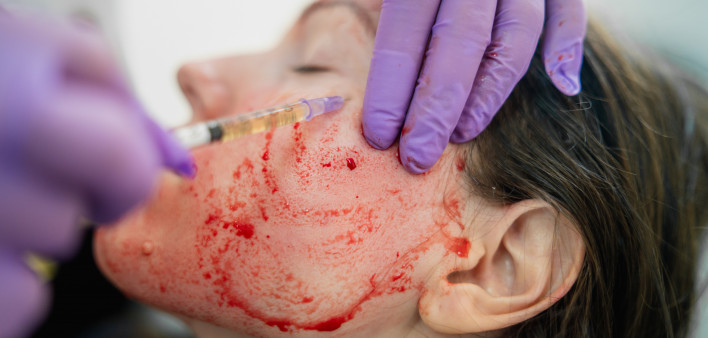 woman gets Revolutionary treatment of rejuvenation with blood plasma vampire facial