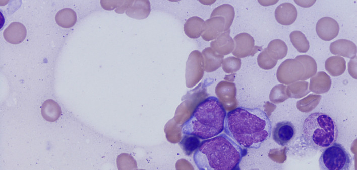 acute myeloid leukemia