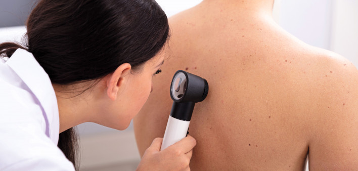 doctor looking for skin cancer melanoma