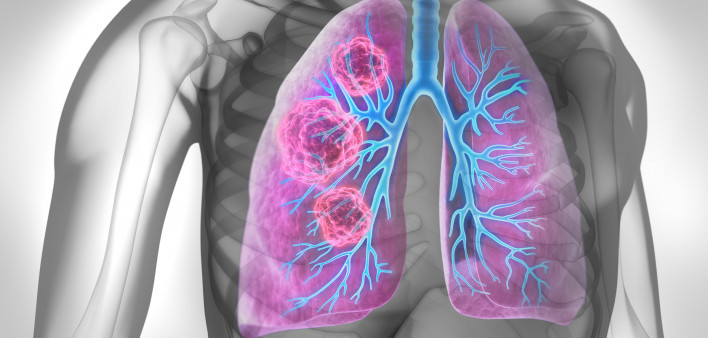Medical Illustration of lung cancer - cancerous area in lungs