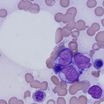 acute myeloid leukemia