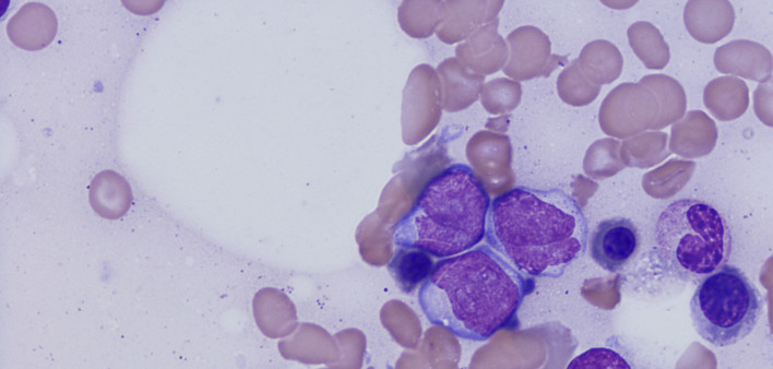 acute myeloid leukemia