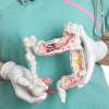 Colon cancer