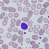 A peripheral blood smear showing several hairy leukemia cells
