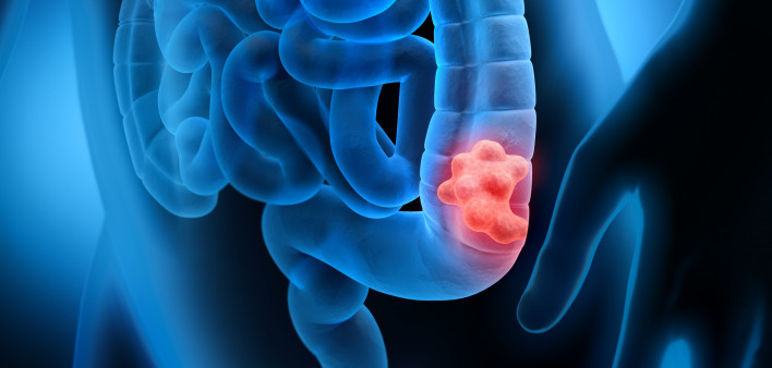 3d illustration of colon cancer