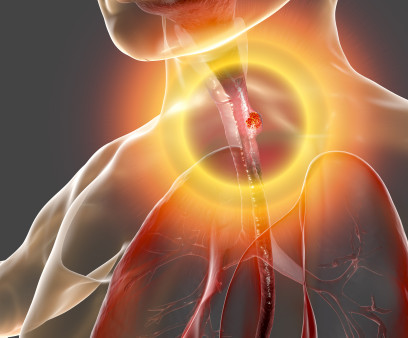 Esophageal cancer, 3D illustration showing malignant tumor in the human esophagus