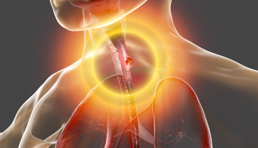 Esophageal cancer, 3D illustration showing malignant tumor in the human esophagus