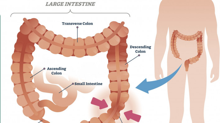 Irritable bowel syndrome
