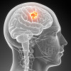 Brain cancer