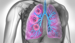 Medical Illustration of lung cancer - cancerous area in lungs
