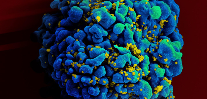 NIAID HIV-infected H9 T cell  Scanning electromicrograph of an HIV-infected H9 T cell.