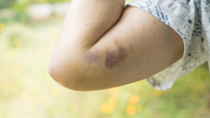 Bruise on womans arm