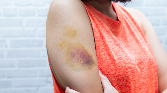 Bruise on womans arm