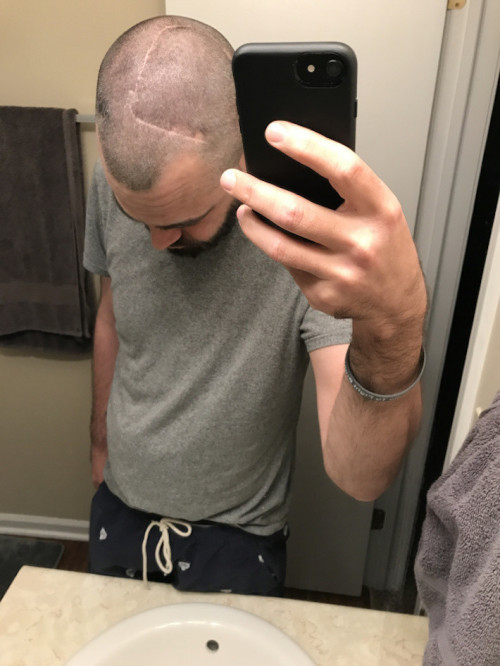 glioblastoma, brain cancer, craniotomy, scar, visible illness, surviving, side effects, guilt