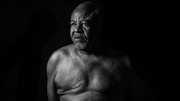 Jose Ferreira, male breast cancer