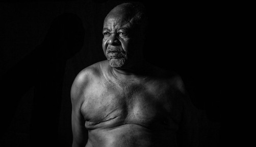 Jose Ferreira, male breast cancer