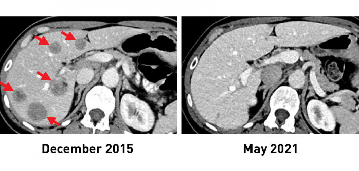 TIL immunotherapy breast cancer