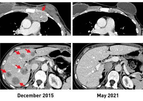 TIL immunotherapy breast cancer
