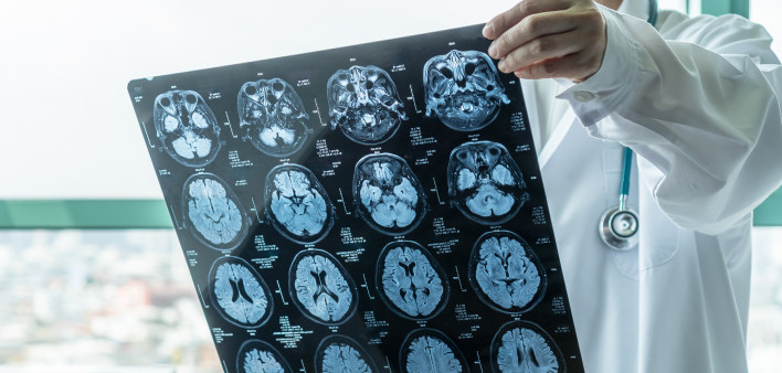 doctor looking at mri of brain