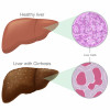 The difference of Healthy liver cells and Cirrhosis