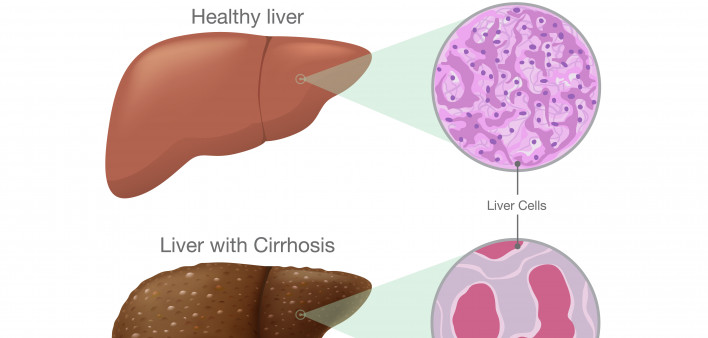 The difference of Healthy liver cells and Cirrhosis