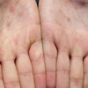 Monkypox lesions on the palms