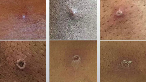 Monkeypox lesions